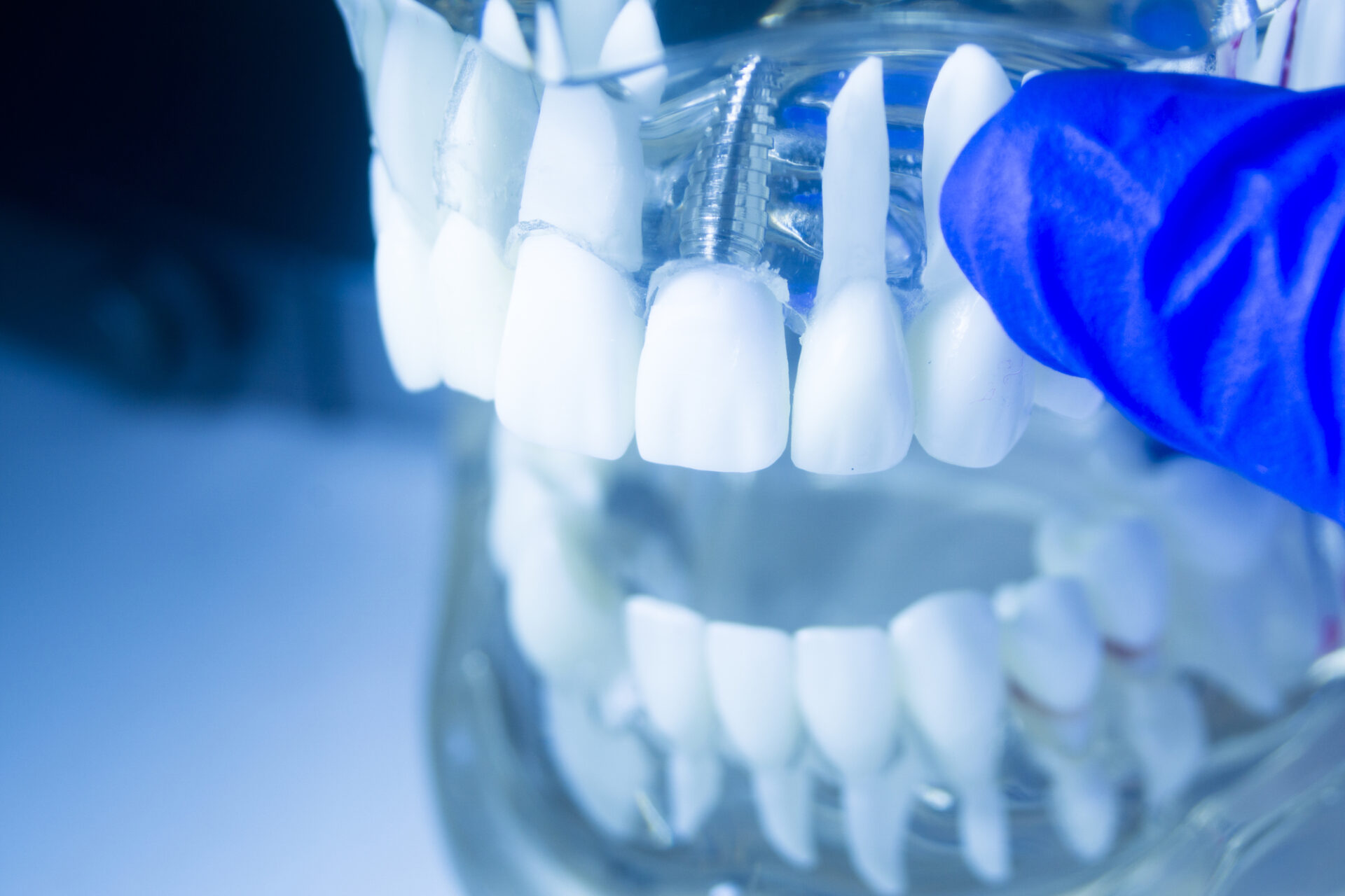 Dental tooth implant model